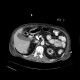 Chronic calcified pancreatitis: CT - Computed tomography